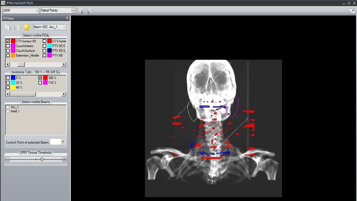 DRR view with superimposed failed points (OCTAVIUS II/4D only)